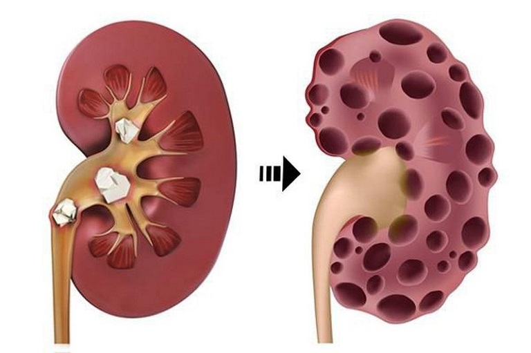 Tuổi tác là một trong những yếu tố khiến người bệnh dễ bị các vấn đề về thận