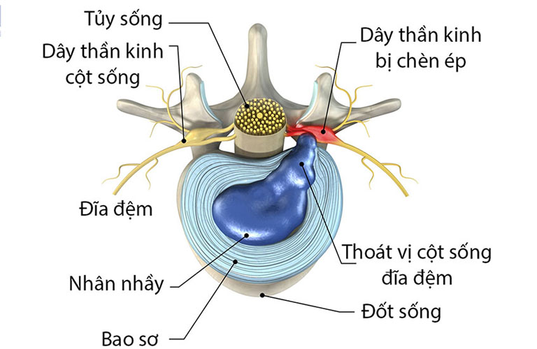 Thoát vị đĩa đệm là các đĩa đệm bị lệch khỏi đốt sống