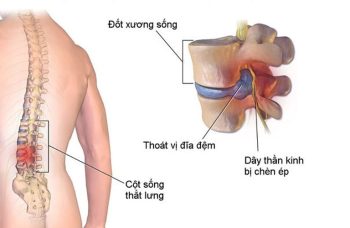 Thoát Vị Đĩa Đệm: Triệu Chứng, Cách Điều Trị Và Phòng Tránh