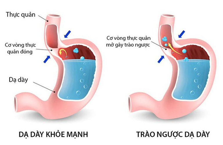 Trào ngược dạ dày là axit và đồ ăn trong dạ dày bị trào ngược lên vùng thực quản