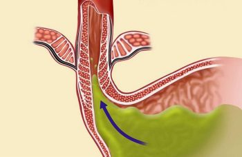 Trào Ngược Dạ Dày: Biểu Hiện, Cách Chữa Trị Và Phòng Tránh