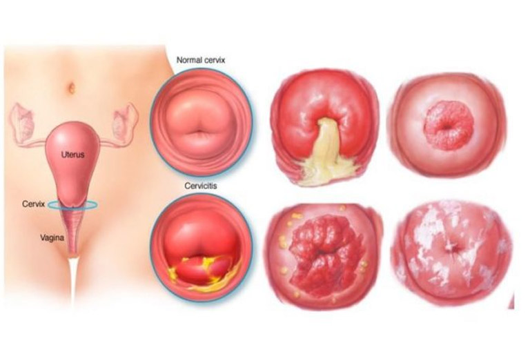 Viêm cổ tử cung là bệnh lý phụ khoa rất thường gặp