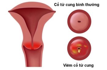 Viêm Cổ Tử Cung: Định Nghĩa, Biểu Hiện, Biện Pháp Điều Trị