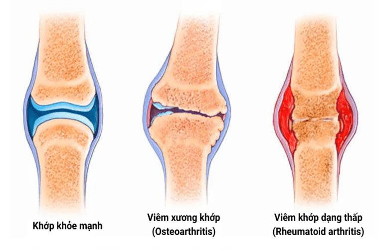 Viêm khớp là tình trạng tổn thương mài mòn các khớp xương trong cơ thể