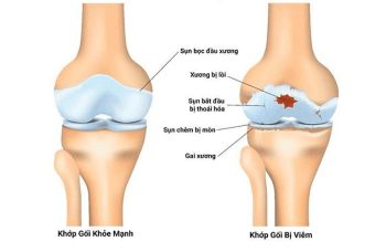 Viêm Khớp: Nguyên Nhân, Biểu Hiện, Cách Chữa Hiệu Quả